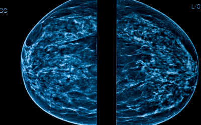 Key Takeaways of Mammograms